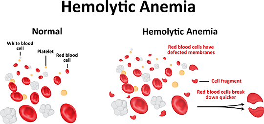 HemolyticAnemia-346367561-540px.png