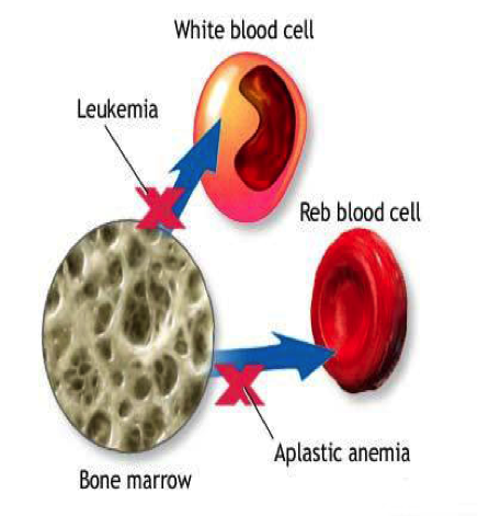 aplasticanemia02.png
