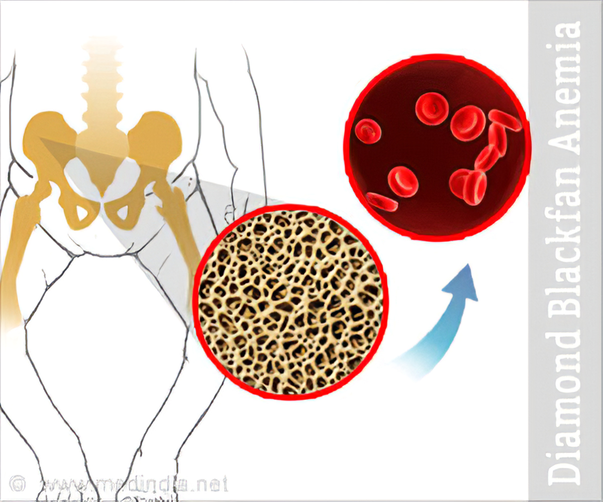diamond-blackfan-anemia.jpg
