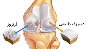آرتروز